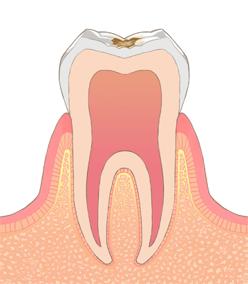むし歯・虫歯の進行 C1