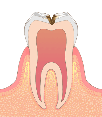 むし歯・虫歯の進行 C2
