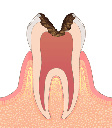 むし歯・虫歯の進行 C3