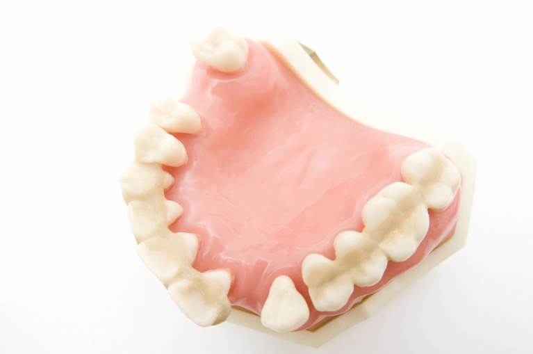 歯周ポケットにたまった歯垢・歯石が炎症を引き起こします